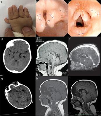 Case Report: Whole-Exome Sequencing of Hypothalamic Hamartoma From an Infant With Pallister-Hall Syndrome Revealed Novel de novo Mutation in the GLI3